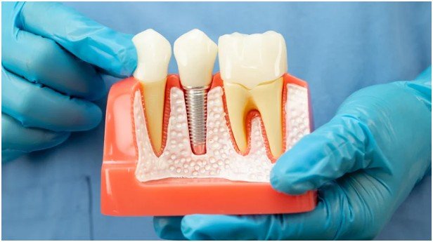 The Advantages of Dental Implants